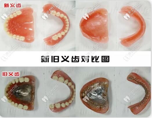 吸附性義齒與普通義齒的區(qū)別