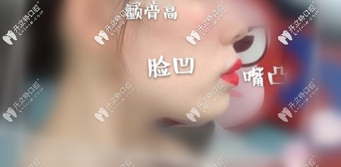 顴骨高、面部凹陷、凸嘴