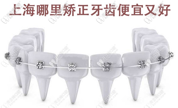 上海哪里矯正牙齒便宜又好，這些有名的牙科醫(yī)院值得選擇