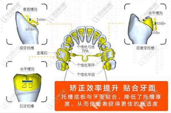 舌側(cè)全隱形矯正的特點(diǎn)