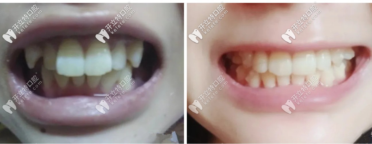 拔了4顆牙后做的隱適美，在濰坊戴隱形牙套的效果還不錯