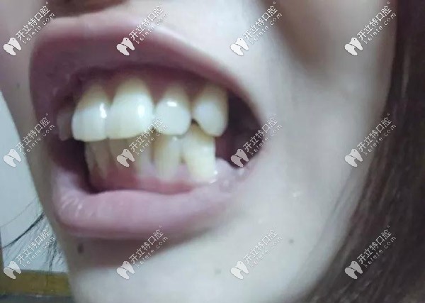 牙齒的側(cè)面照，外凸的厲害