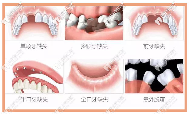 瑞典諾貝爾種植系統(tǒng)適應癥