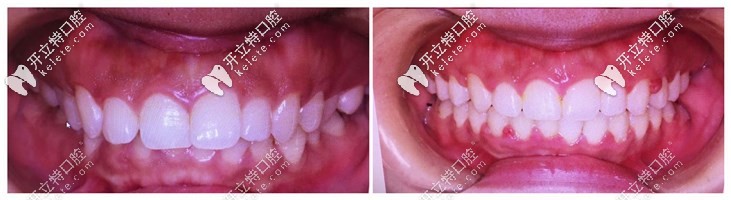 我做了Angelalign隱形矯正牙齒效果還不錯(cuò)，花多少錢都值得