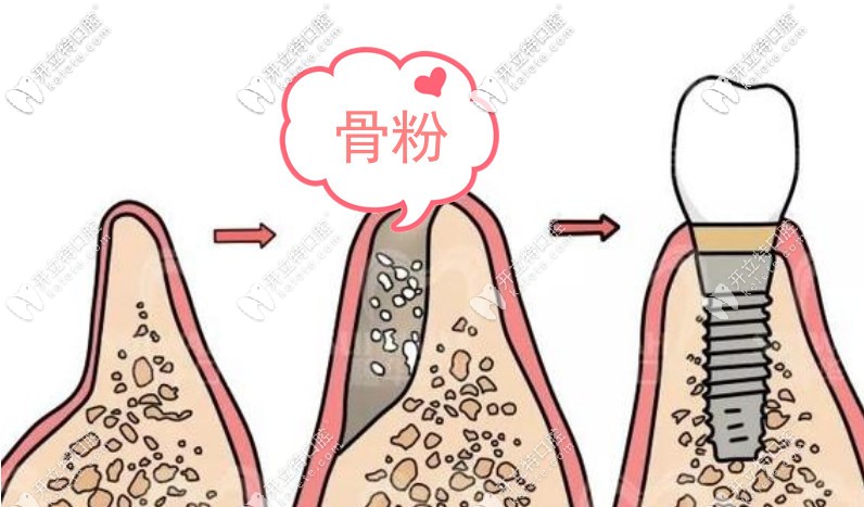 骨粉的價格是多少