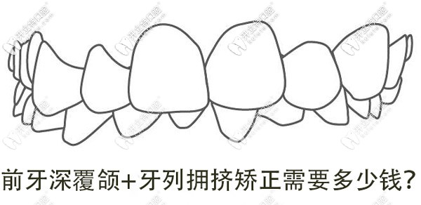 牙列擁擠+深覆合，想矯正牙齒做手術(shù)需要多少錢呢？
