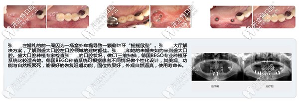 沈陽(yáng)盛大口腔多顆牙缺失