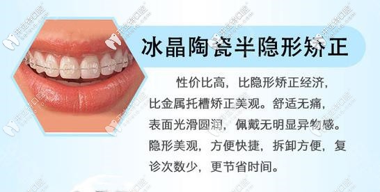 半隱形陶瓷牙齒矯正器優(yōu)勢(shì)