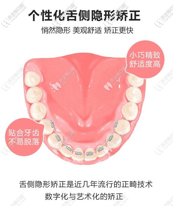 個(gè)性化舌側(cè)矯正的優(yōu)勢