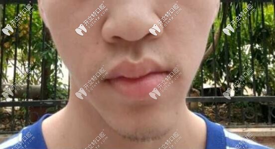 骨性偏頜