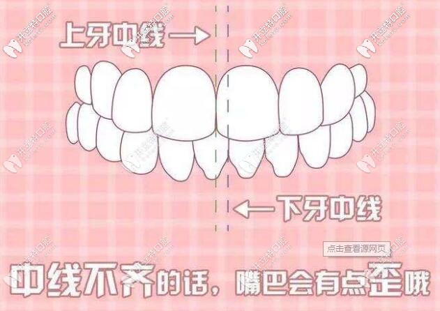 牙性偏頜