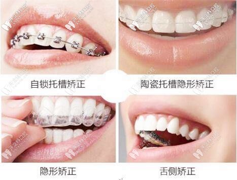 牙套的四種類(lèi)型_副本.jpg