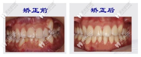 矯正前后對比