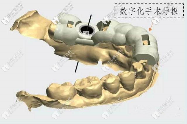 數字化導板種植