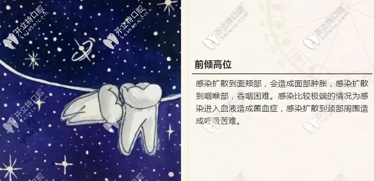 前傾高位