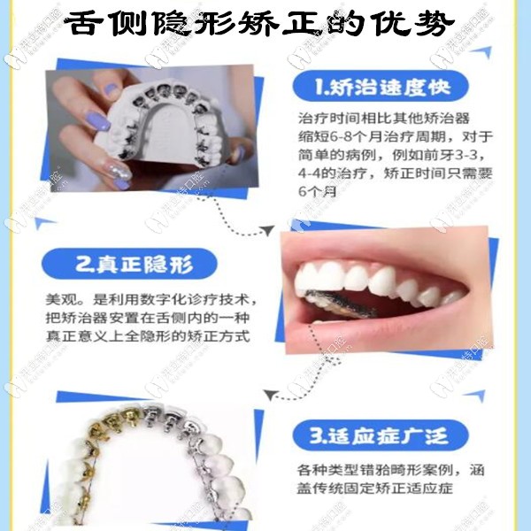 舌側隱形矯正的優(yōu)勢