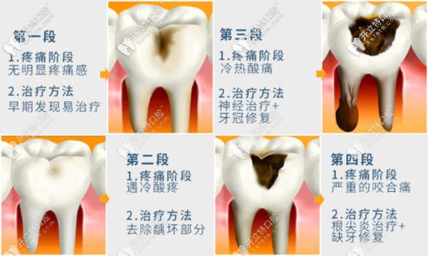 山東棗莊補(bǔ)牙類(lèi)型的價(jià)格