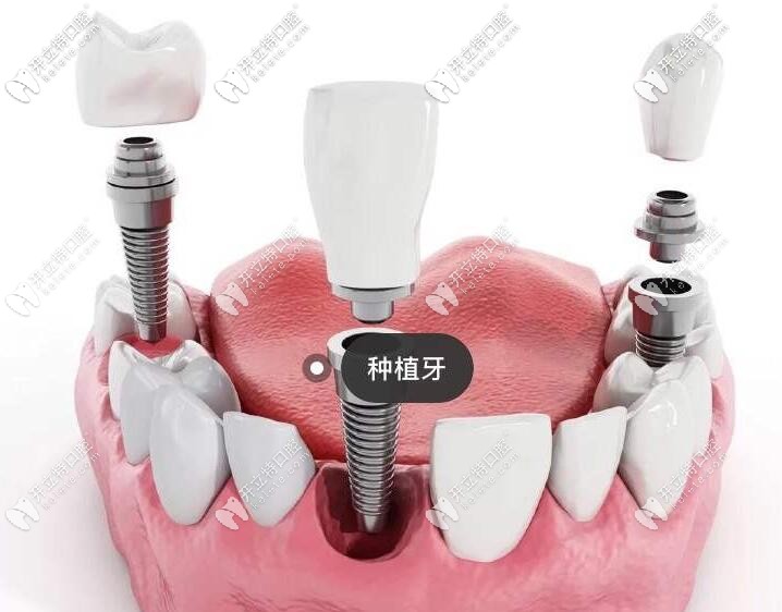 牙齒種植 牙齒種植