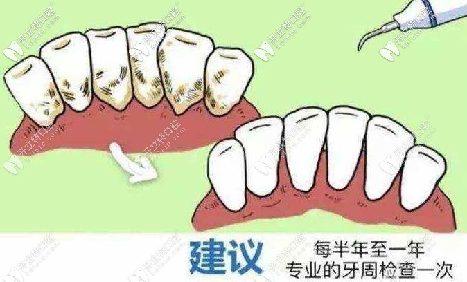 牙周治療 牙周治療