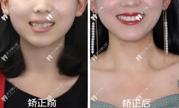 哇~22歲重度齙牙的我做了正雅日夜版隱形矯正竟然逆襲！