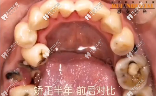 由于牙齒擁擠導致蛀牙較多