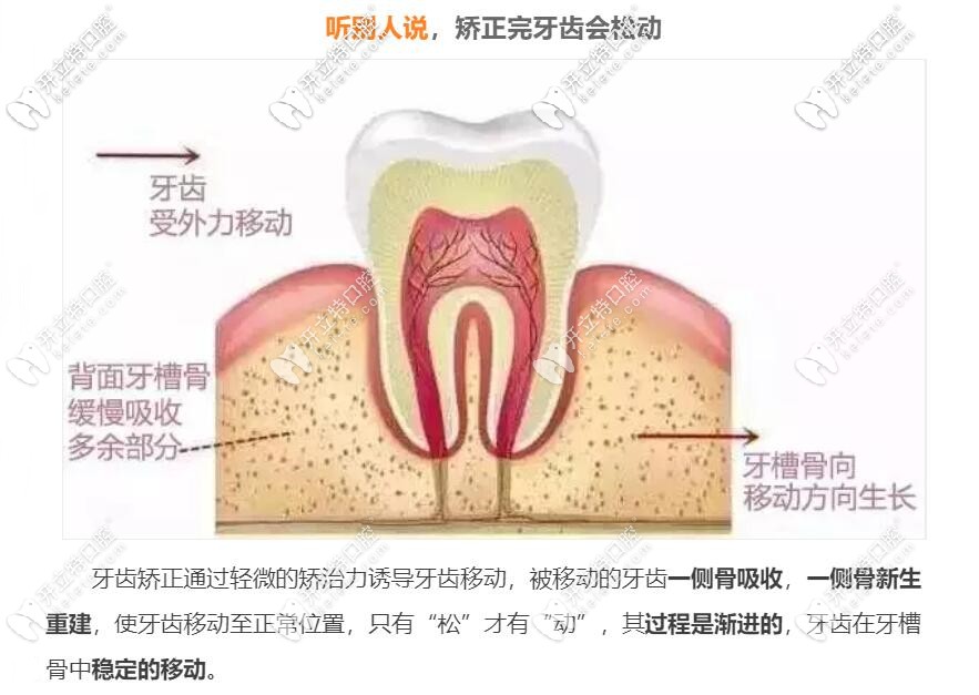 矯正完牙齒會松動嗎