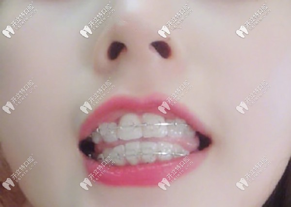 戴牙套半年后