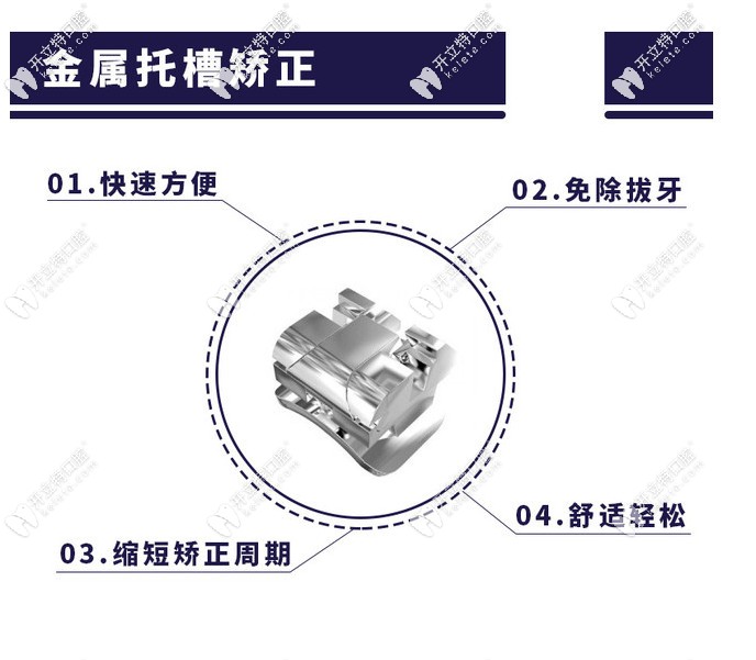 成都自鎖托槽矯正價格