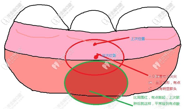 牙周膿腫也會引起牙齒疼痛