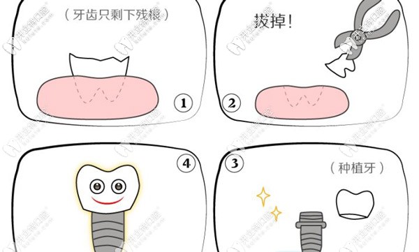 種植牙的流程圖