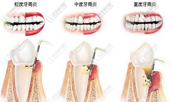 上海哪里有丹麥水冷激光治療，大概需要多少費(fèi)用？