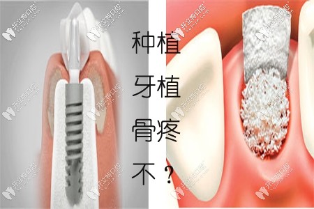 天哪！種植牙填骨粉太疼了？上門牙種植一定要植骨粉嗎