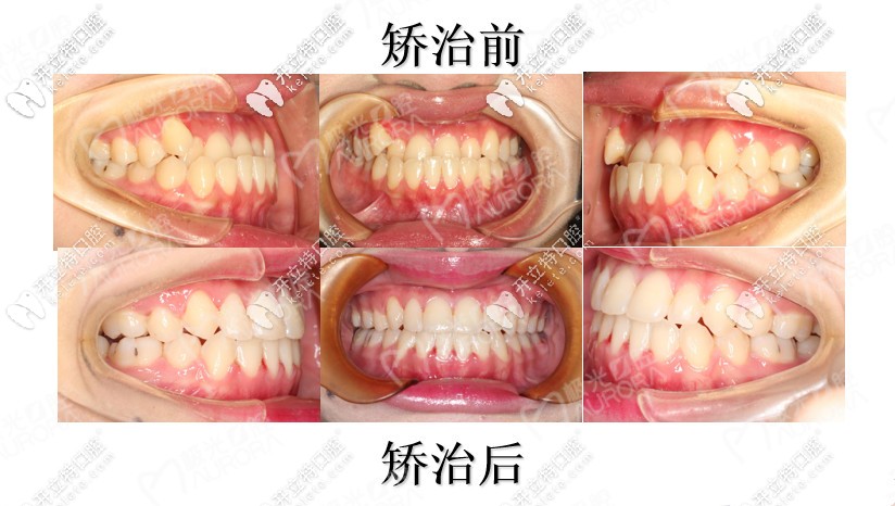 矯正案例