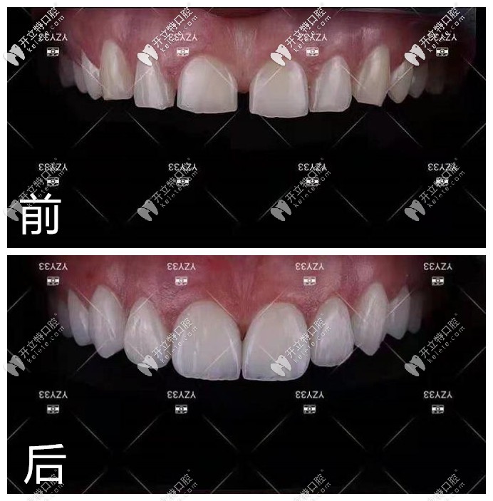 納米水晶瓷貼面修復(fù)半口牙前后對(duì)比照片