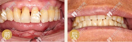種牙前后對比
