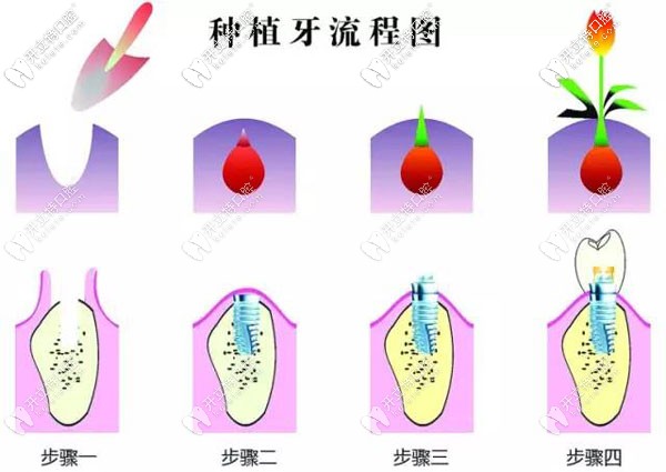 種植牙手術(shù)過程圖