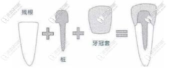 做牙套要打樁這波操作疼嗎?分享烤瓷牙打樁材料及價(jià)格