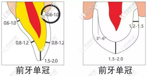 前牙冠做備牙的圖解