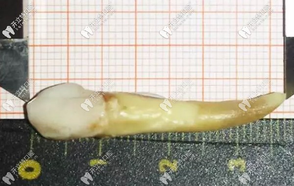 人的智齒較長(zhǎng)有幾厘米，3.72厘米的牙齒你見(jiàn)過(guò)嗎？