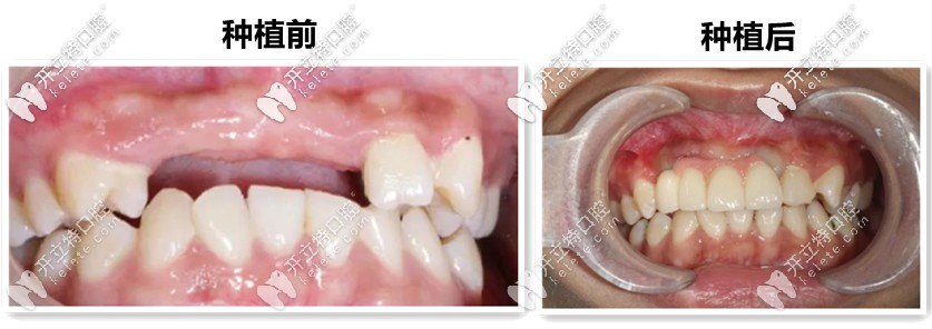 種植牙前后對(duì)比圖