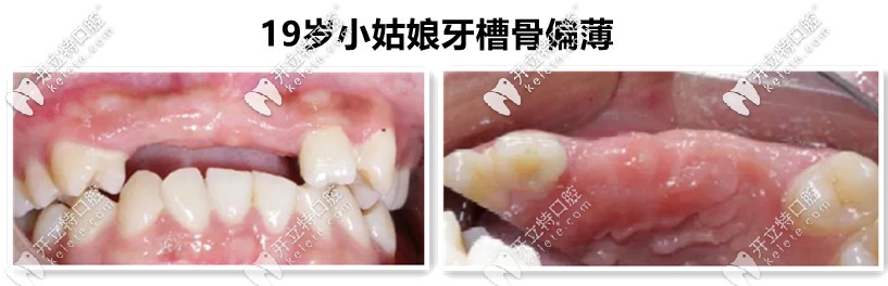 牙槽骨不足，需要植入骨粉