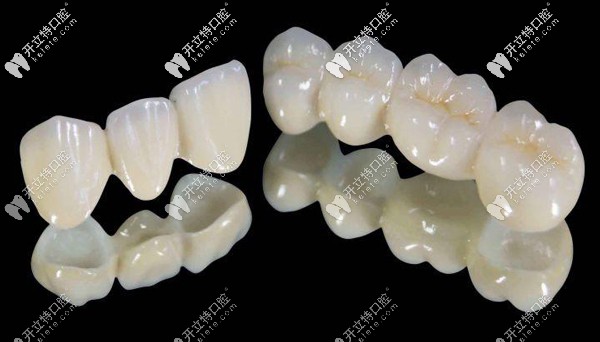 樂瓷全瓷牙價(jià)格是多少，怎么辨別德國(guó)樂瓷牙冠真假呢？