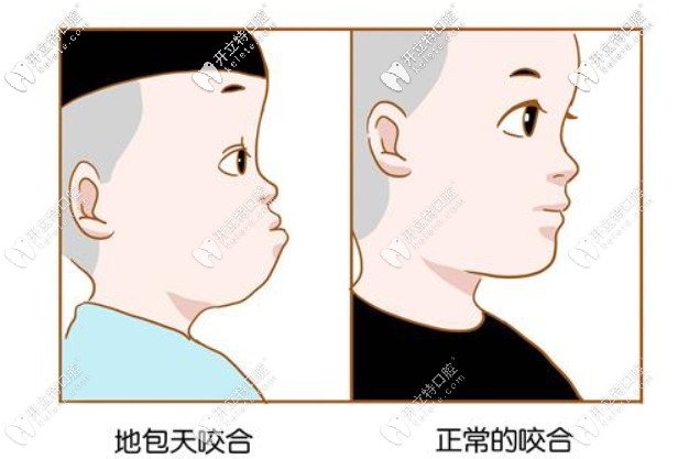 牙齒地包天有必要治嗎？哪個(gè)年齡階段矯正比較好