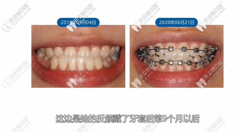 反頜牙套9個(gè)月