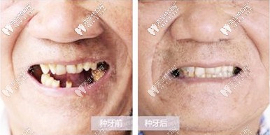 種牙前后對比