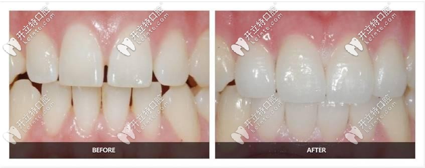 美萊口腔：黃麗瓊醫(yī)生—牙貼面修復(fù)案例