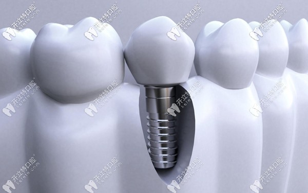 韓國登騰Dentium種植體的優(yōu)點(diǎn)