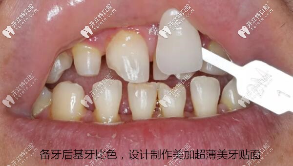 備牙后基牙比色，設(shè)計(jì)制作美加超薄美牙貼面