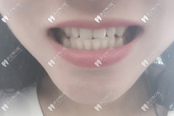 牙齒做完牙冠后的照片