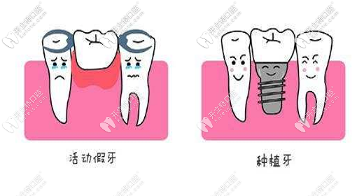 牙齒缺失的修復(fù)方式